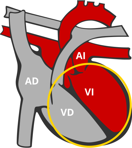 Miocardiopatia dilatada MCD