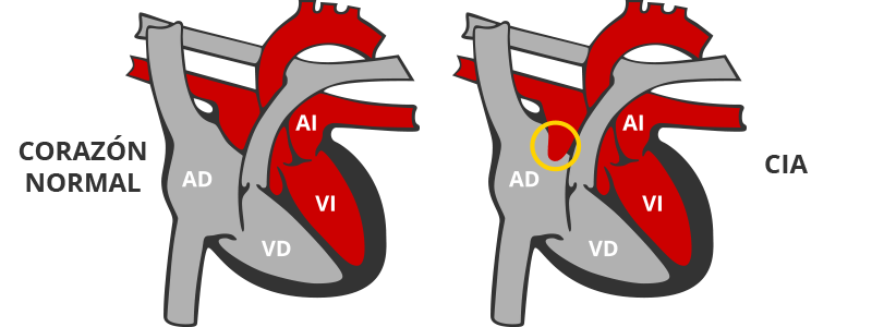 comunicación interventricular es un tipo de cardiopatía congénita
