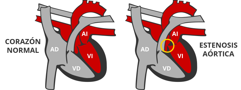 estenosis pulomar es un tipo de cardiopatia congénita