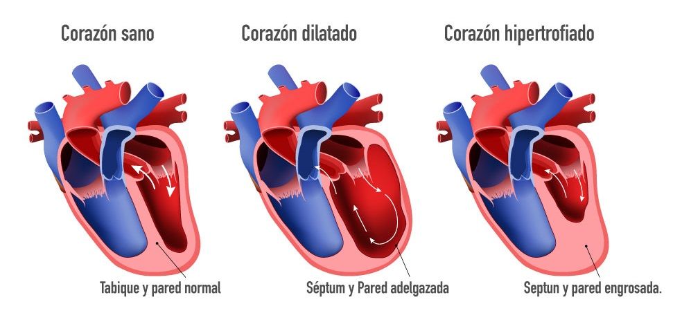 tipos de miocardiopatía